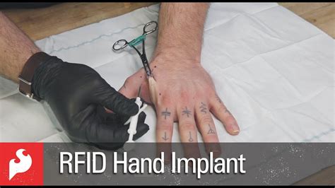 rfid tag implant|rfid implants in the hand.